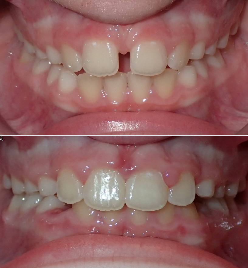 Before and after orthodontic transformation - Stellar Orthodontics patient C.B.
