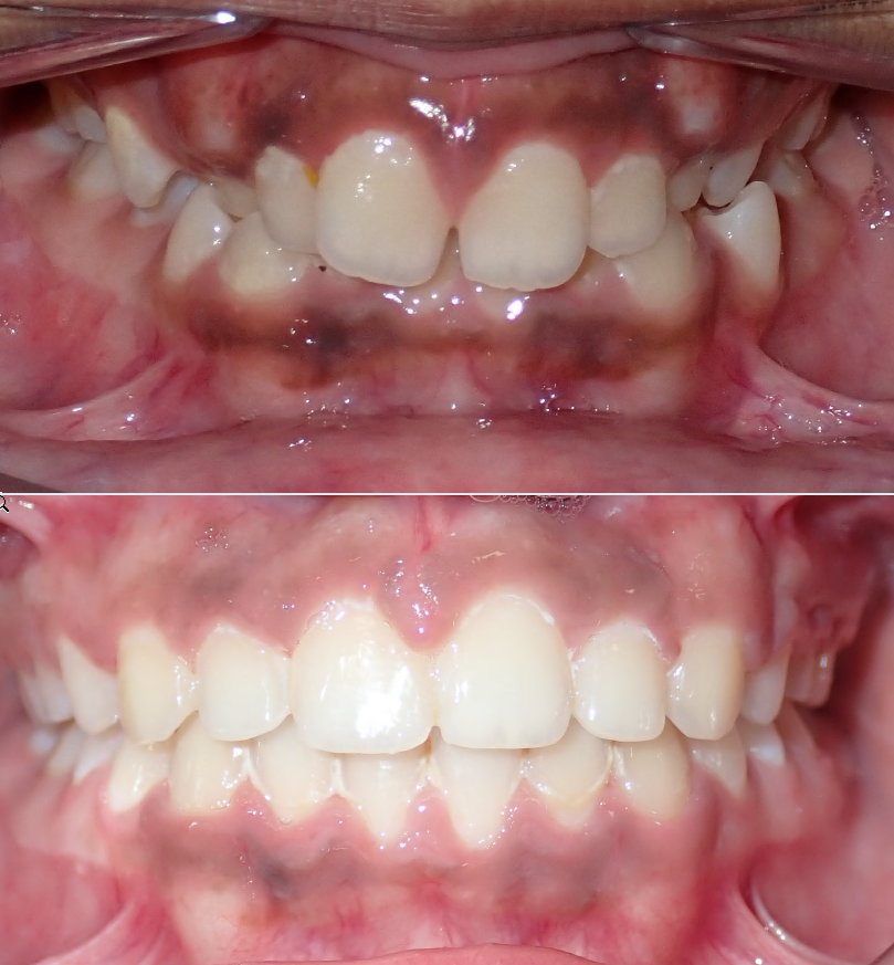 Before and after orthodontic transformation, Stellar Orthodontics patient D. Patel