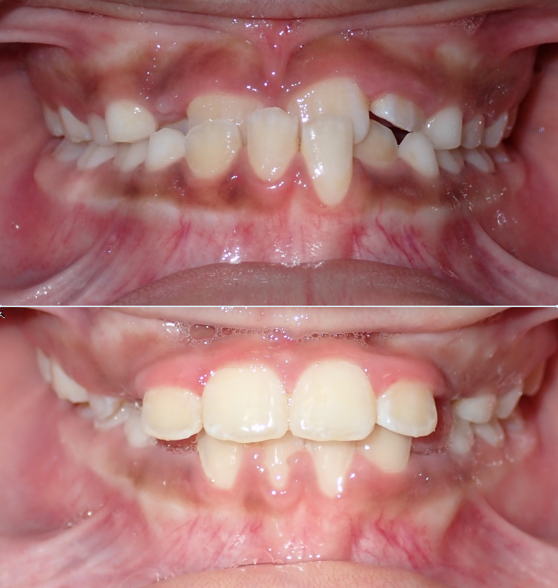 Before and after orthodontic transformation - Stellar Orthodontics patient E.E.