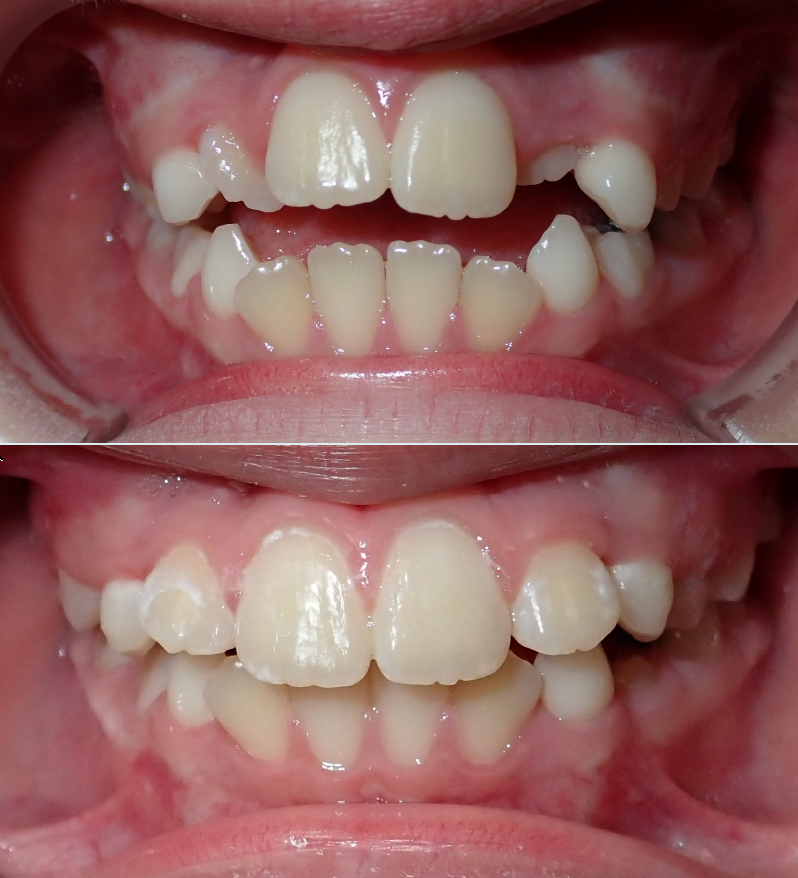 Before and after orthodontic transformation, Stellar Orthodontics patient J. Mercado-Ruiz