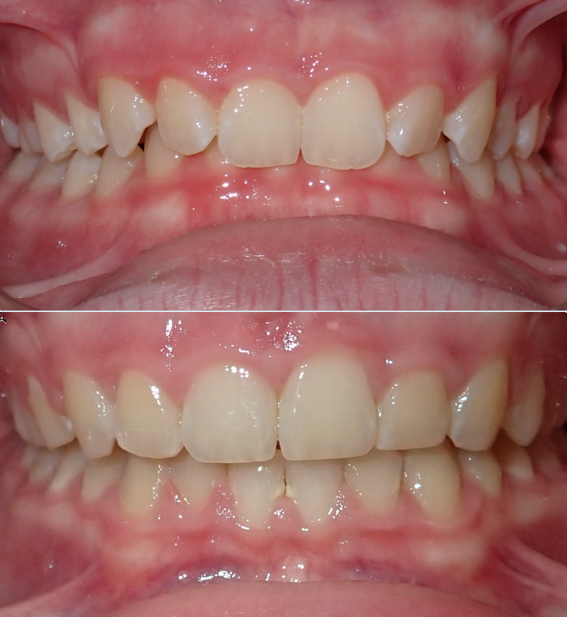 Before and after orthodontic transformation - Stellar Orthodontics patient L.O.